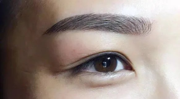 眼皮抽脂手术痛吗