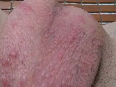 湿疹阴囊症状图片