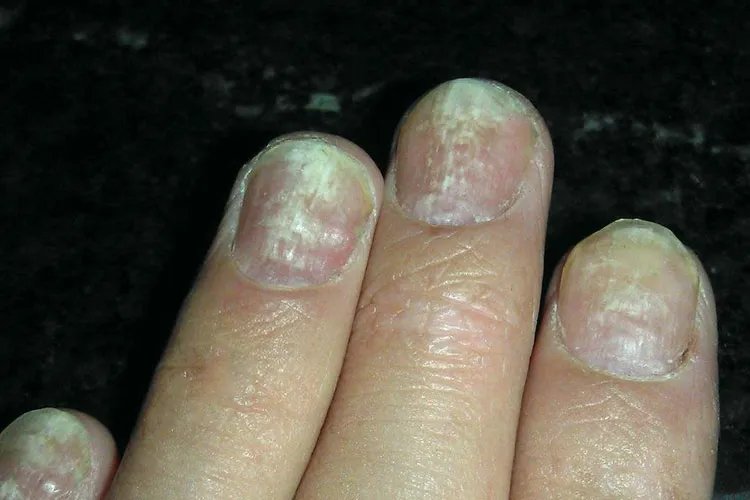 灰指甲早期图片