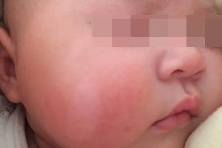 宝宝身上有白色斑块图片