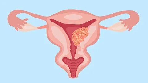 腺肌症是什么病严重吗