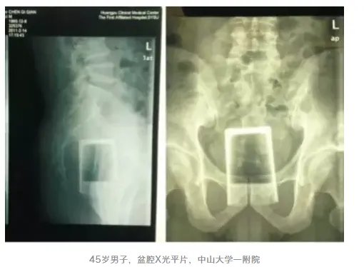 别往菊花和丁丁里塞奇怪的东西了,取出来的时候很疼的!