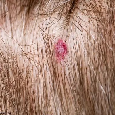 左枕部头皮血肿可以热敷吗 头皮血肿如何热敷