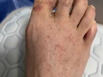 水疱型足癣小水疱图片