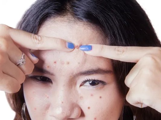 快速祛痘的产品