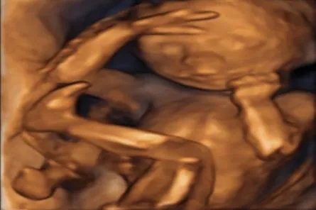 胎儿的四维彩超图片