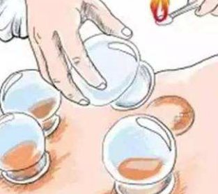 拔罐减肥会反弹吗