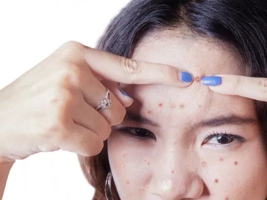 复方痤疮平治疗痤疮的优势