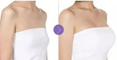 娜高假体价格是多少?