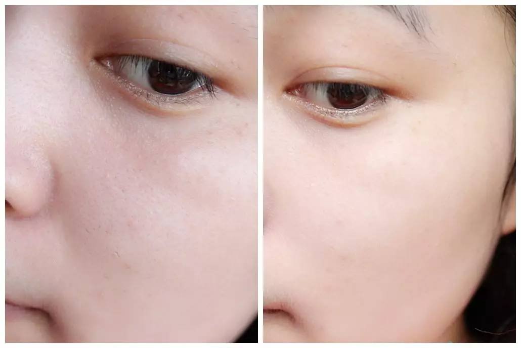 彩光嫩肤到底怎么样