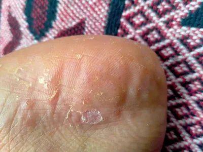 水疱型足癣小水疱图片