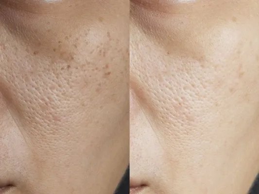 甘油美白的方法