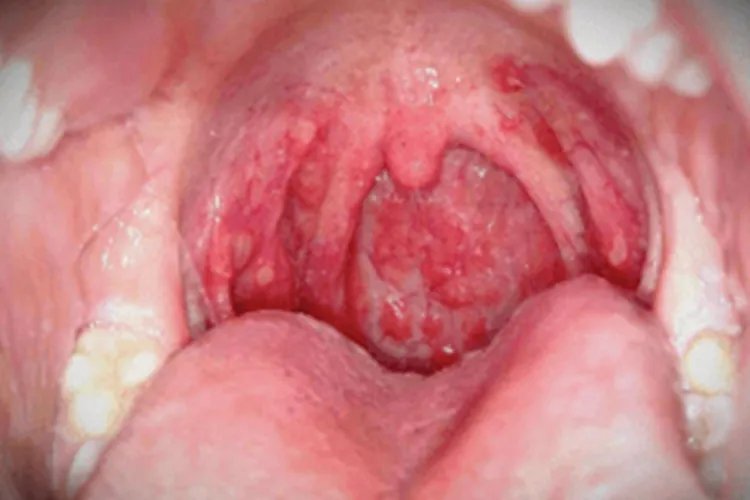 猩红热症状图片