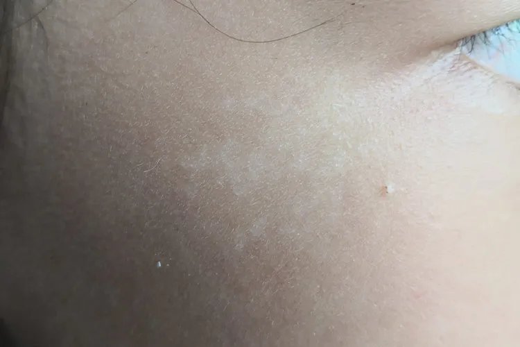 宝宝身上有白色斑块图片