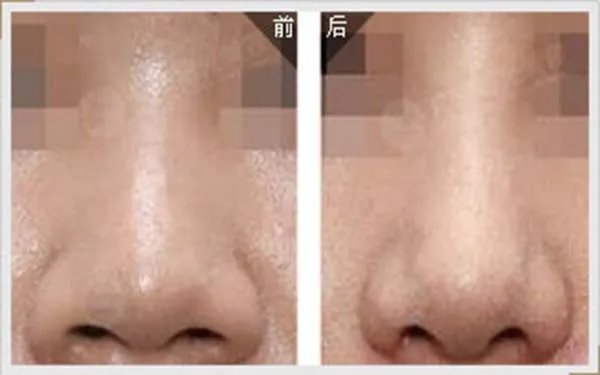 鼻头缩小整形北京哪家医院好