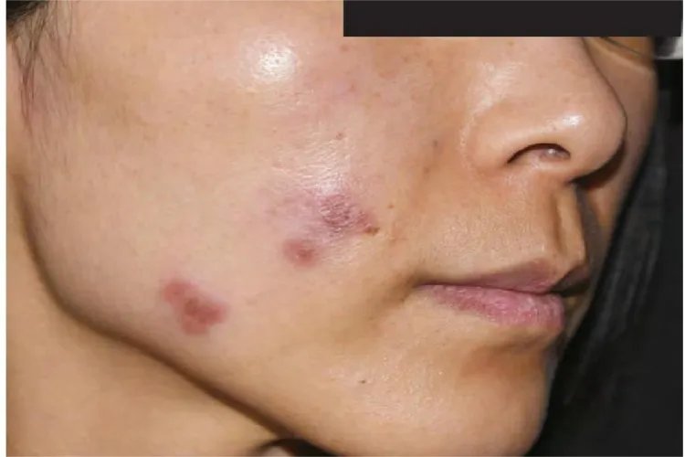 红斑狼疮早期10个征兆图片