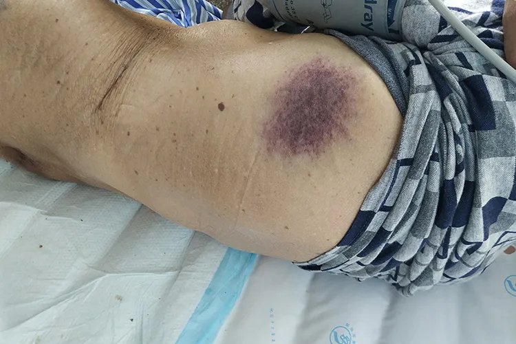 白血病出血点图片