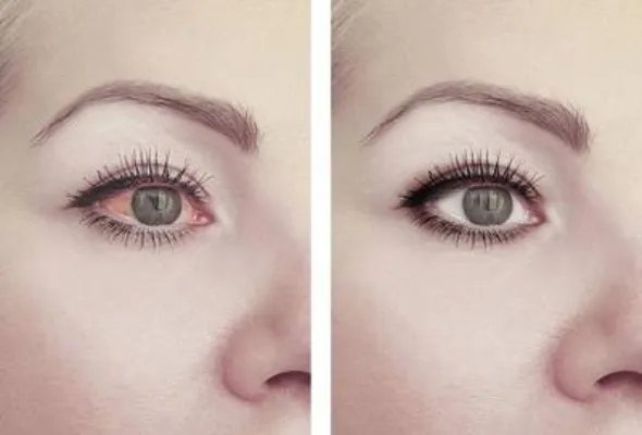 鼻子上有红血丝怎么治疗才对呢