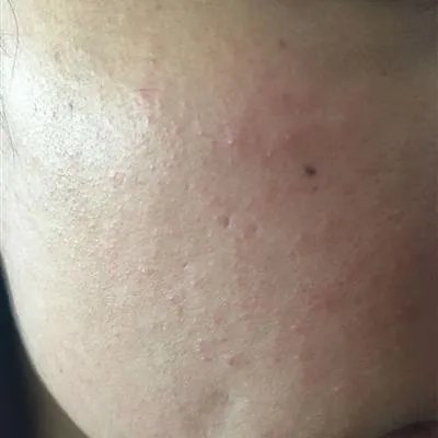 痤疮疙瘩是什么原因