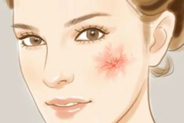 推荐去除红血丝五种小偏方