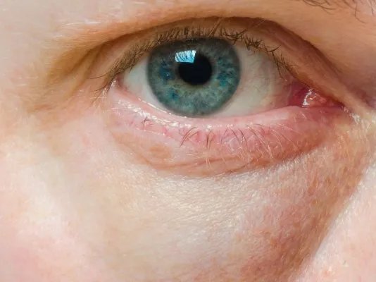 眼袋下垂可以恢复吗