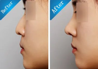 瑞兰玻尿酸隆鼻价位