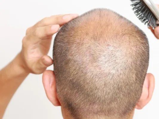 毛发加密有什么好处