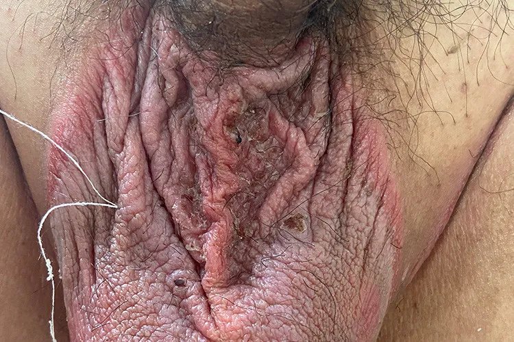 湿疹阴囊症状图片