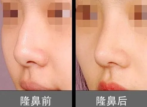 肋软骨隆鼻自体软骨隆鼻前后对比