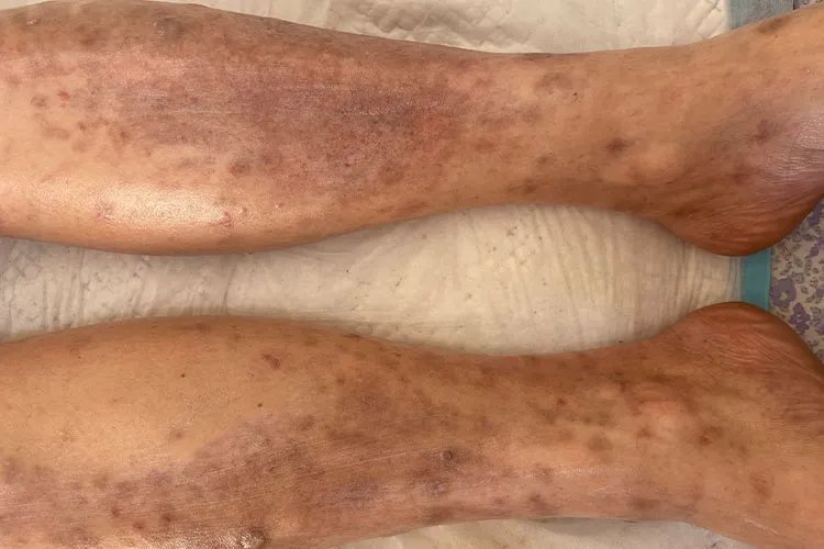 皮炎性湿疹的症状图片