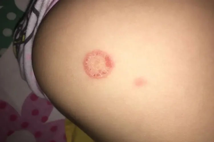 婴儿长圆圈癣的图片