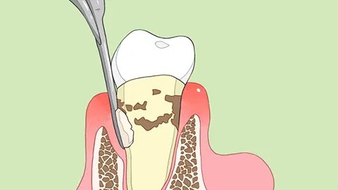 即刻种植牙好吗