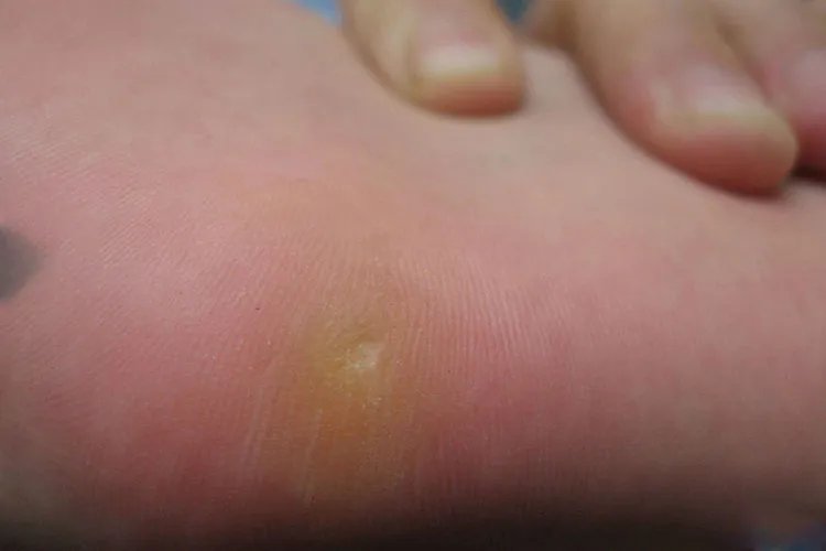 鸡眼刚开始的时候什么样子