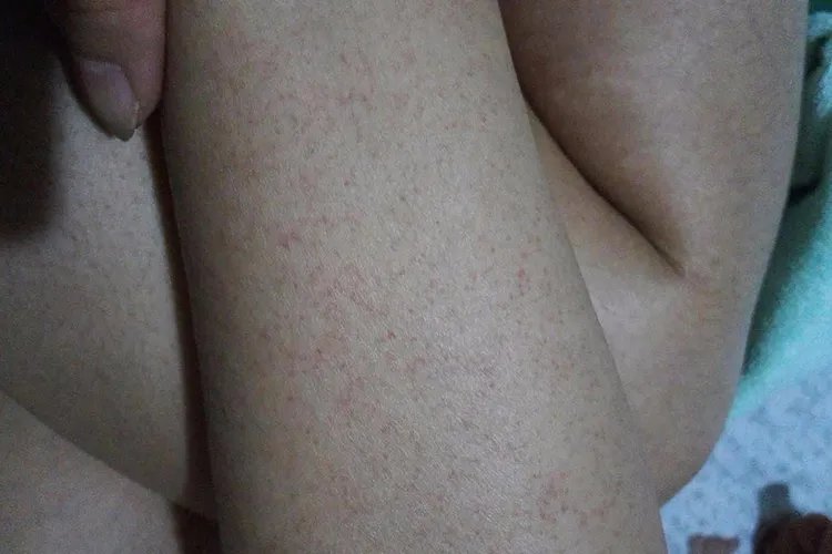 白血病出血点图片