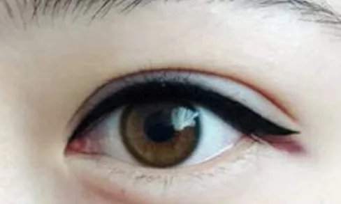 开眼角修复手术恢复时间