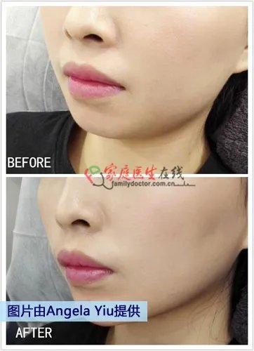 带你到香港寻找微整形新概念