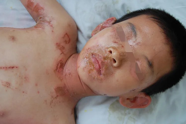 皮炎性湿疹的症状图片