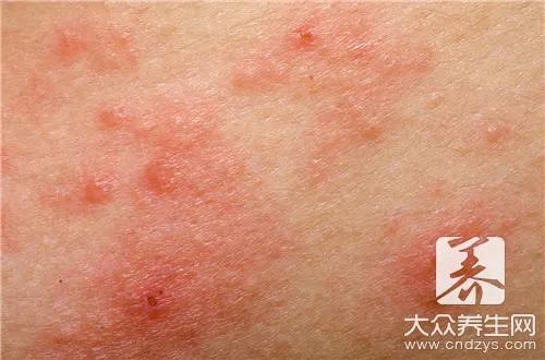  身上起了好多红疙瘩很痒怎么办