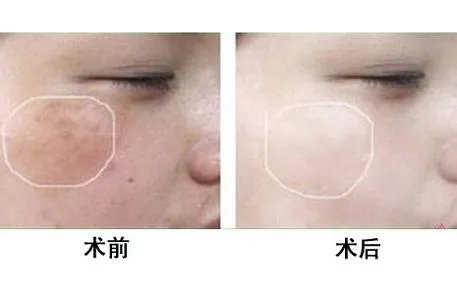 北京彩光嫩肤美白效果怎么样