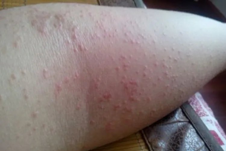 全身过敏症状图片