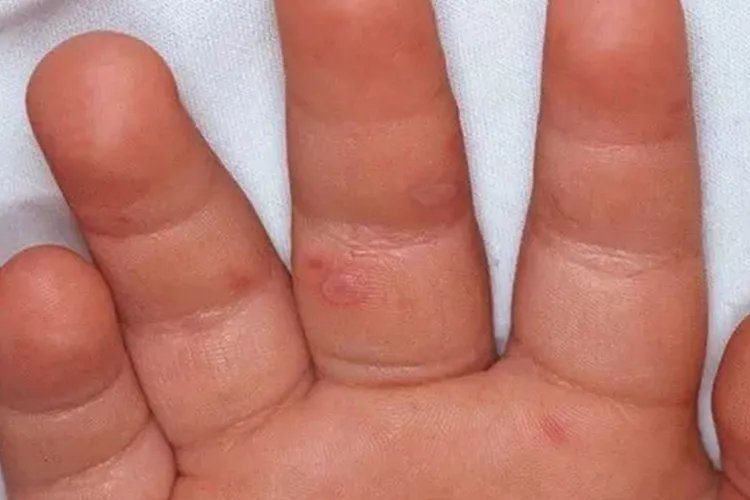 手足口病的样子图片