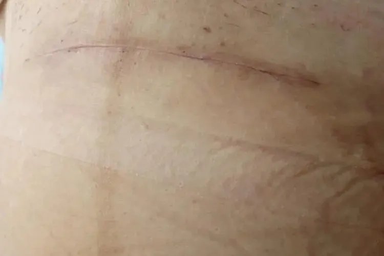 乳腺癌刀口恢复好的图片