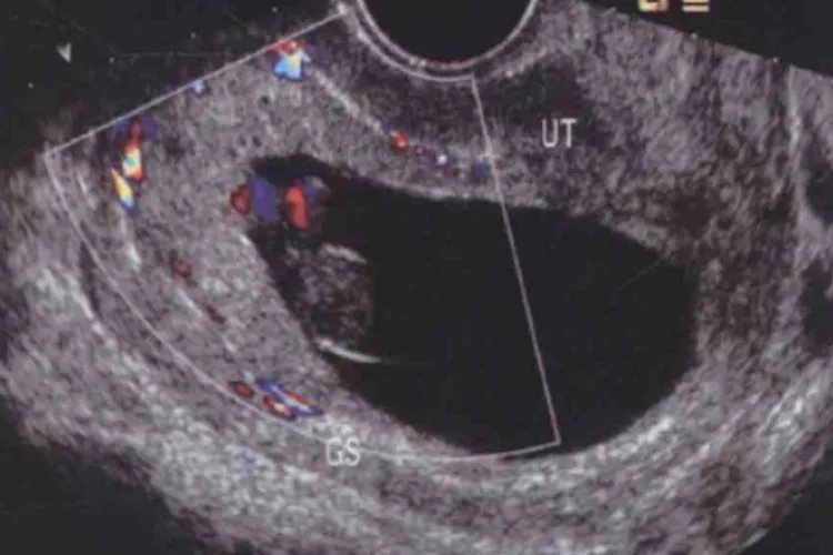 怀孕二个月胎儿彩超图