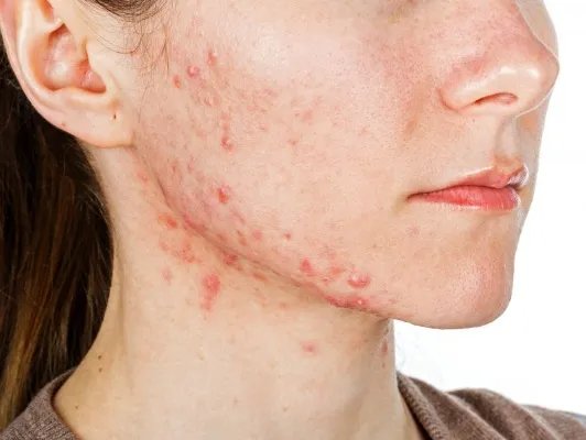 怎样快速去除青春痘