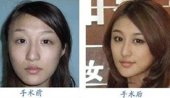刘羽琦整容前后照片对比曝光    其承认自己整容