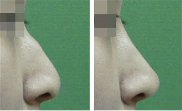 驼峰鼻手术多少钱