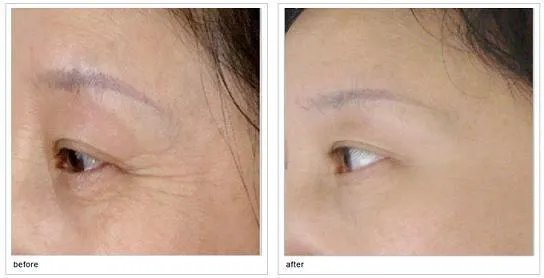 打botox瘦脸针的价格