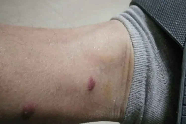 丘疹性荨麻疹脚踝症状图片