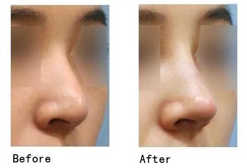 最安全的隆鼻材料