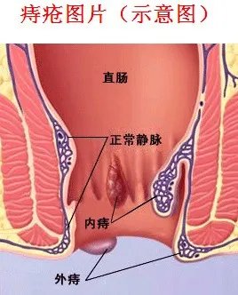 正常屁眼图与痔疮图片：女性痔疮图片,症状及其危害